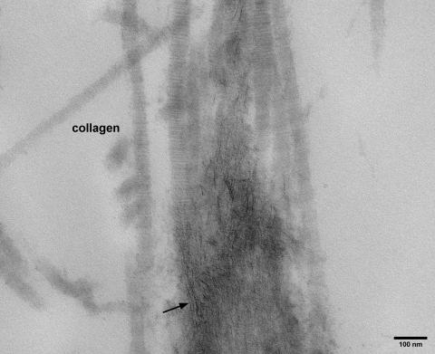 Higher magnification reveals the banding of individual collagen fibres and the electron-dense crystals of calcium phosphate platelets (arrow) marking the start of matrix calcification.