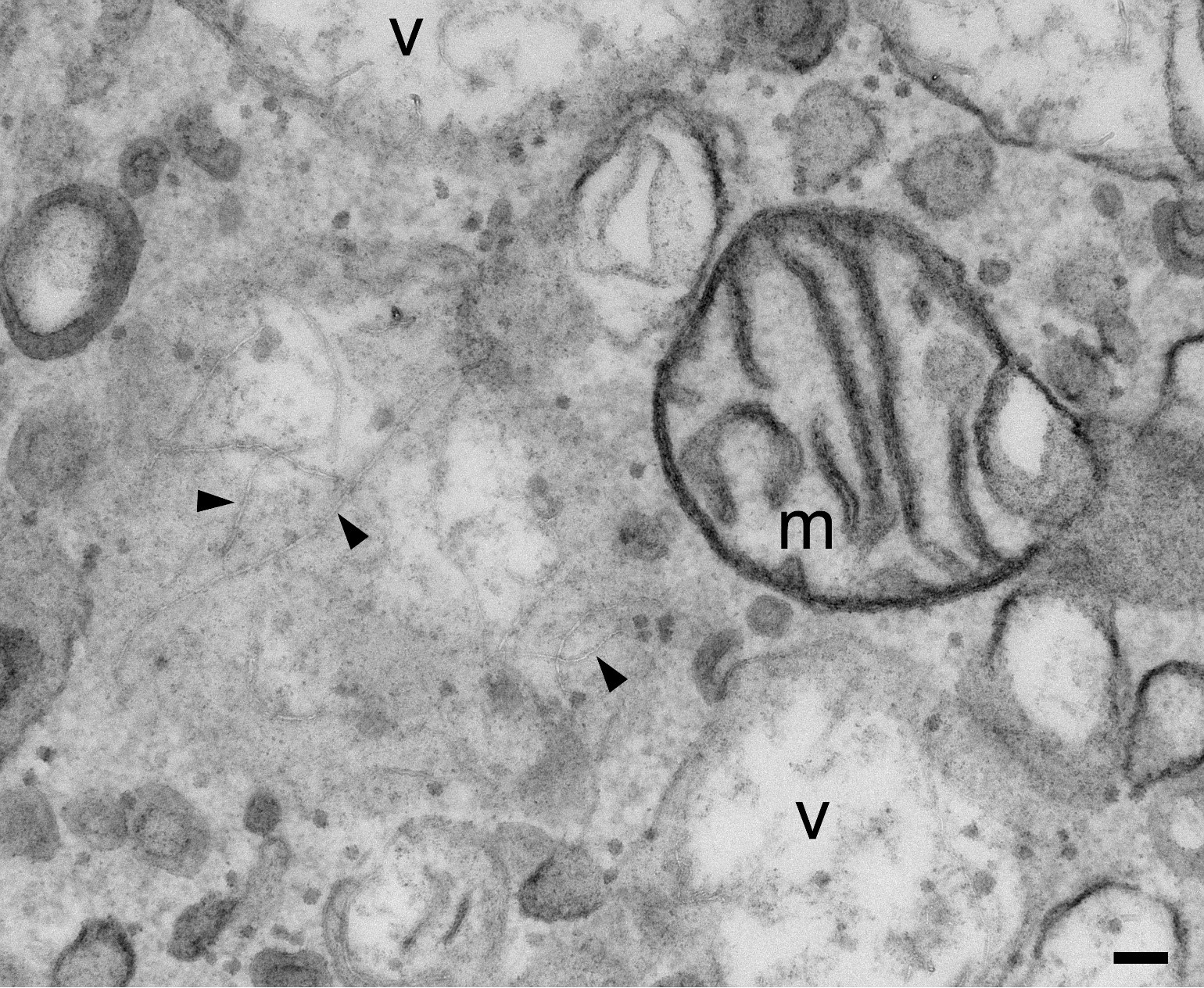 Uptake of multi-walled carbon nanotubes by human macrophages in culture; arrowheads indicate MWCNTs, m = mitochondria, v = intracellular vesicles; scale bar is 100 nm (doi: 10.1021/acsbiomaterials.6b00197).